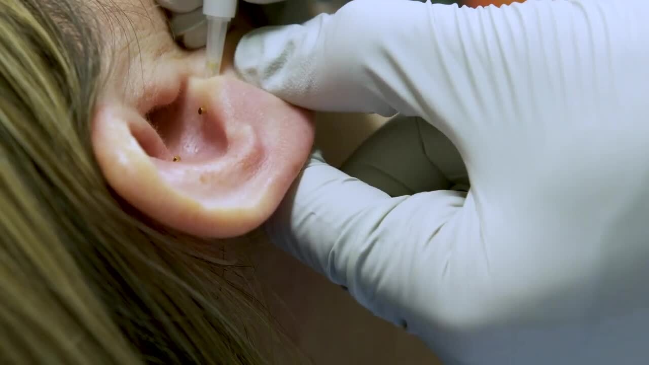 Acupuncture at Children's Mercy
