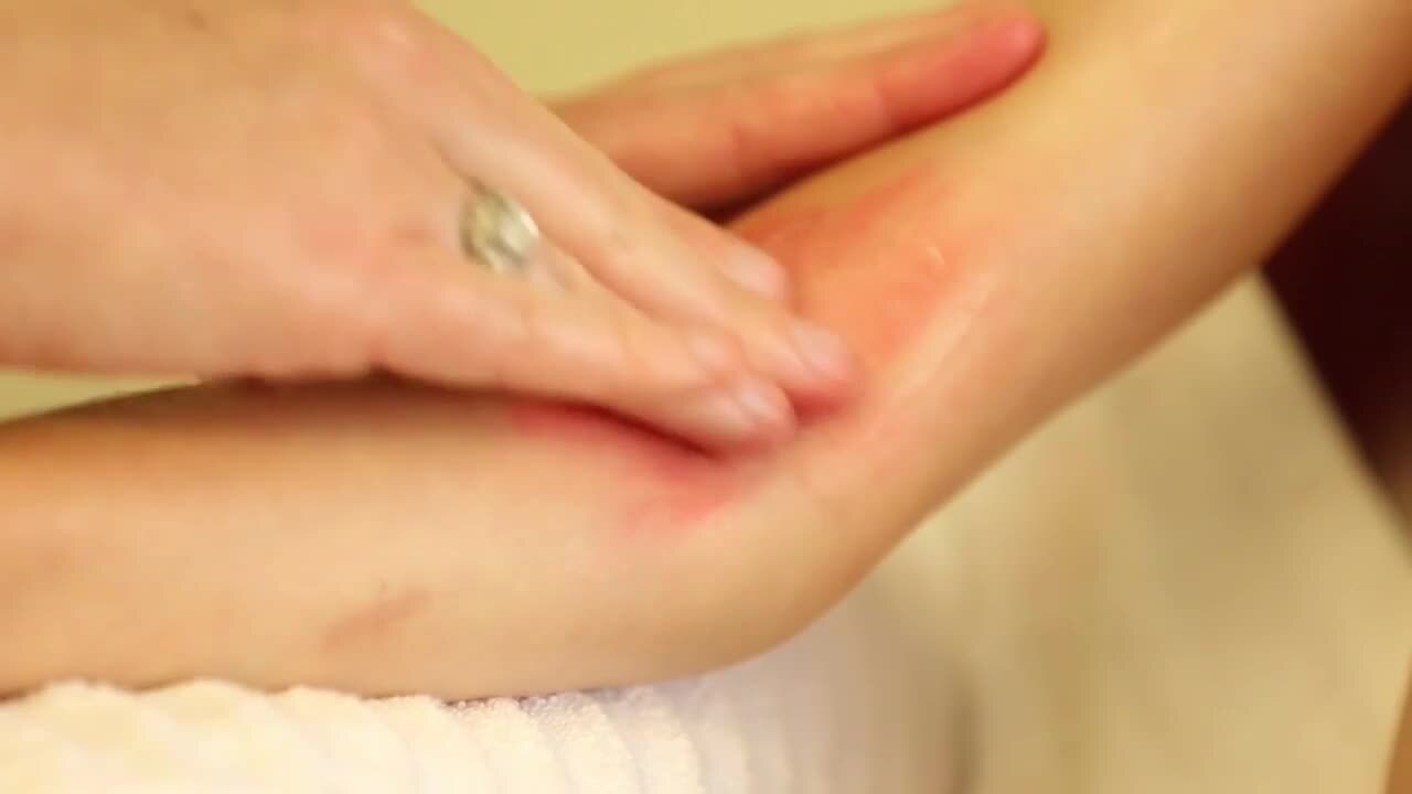 The staff at Children's Mercy describe wet wraps and how they are used to help with eczema