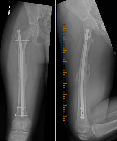 An x-ray of a broken femur.