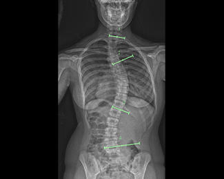 X-ray of curved spine before ApiFix placement