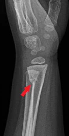 Side-view (lateral) x-ray of the left wrist. The red arrow shows a fracture in the arm bone near the wrist (distal radius fracture). There is also a fracture near the wrist in the ulna, the other bone in the forearm.