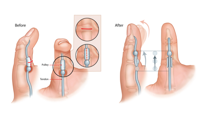 An illustration showing a thumb before and after surgery to correct trigger thumb.