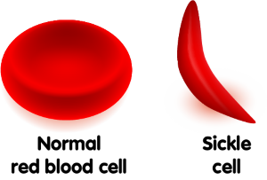 A sickle cell disease blood cell compared to a normal red blood cell.