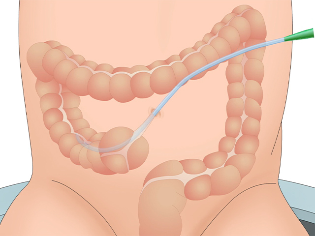 An illustration of a catheter further entering the stoma and colon of a child.