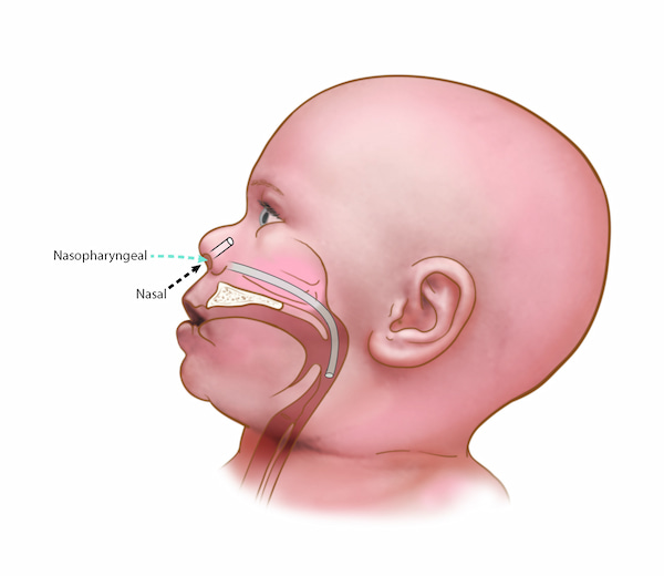 An illustration demonstrating nasopharyngeal suction on an infant.