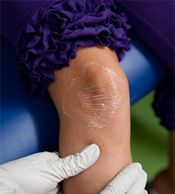 A patient's knee with numbing cream and a clear bandaged applied to it.