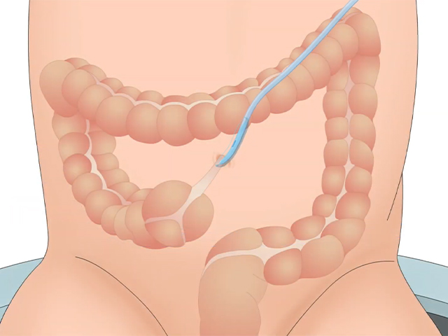 An illustration of a catheter entering the stoma of a child.