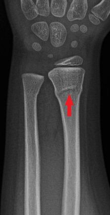Front-view (anteroposterior) x-ray of the left wrist. The red arrow shows a fracture in the arm bone near the wrist (distal radius fracture). There is also a fracture near the wrist in the ulna, the other bone in the forearm.