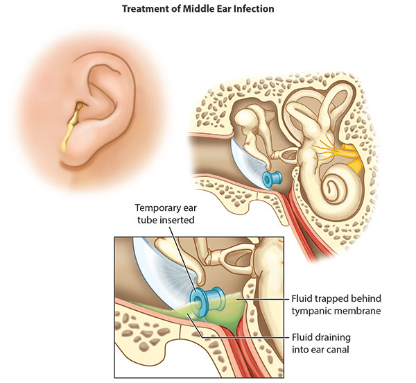 Treatment of Middle Ear Infection illustration, including exterior ear with drainage, healthy interior ear showing ear tube, and infected interior ear with ear tube and trapped fluid