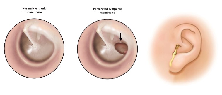 Illustrations showing a normal tympanic membrane, a perforated tympanic membrane and yellow drainage coming out of an ear.