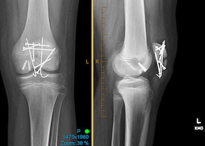 An x-ray of a shattered kneecap that was repaired with surgical screws, wires and sutures.
