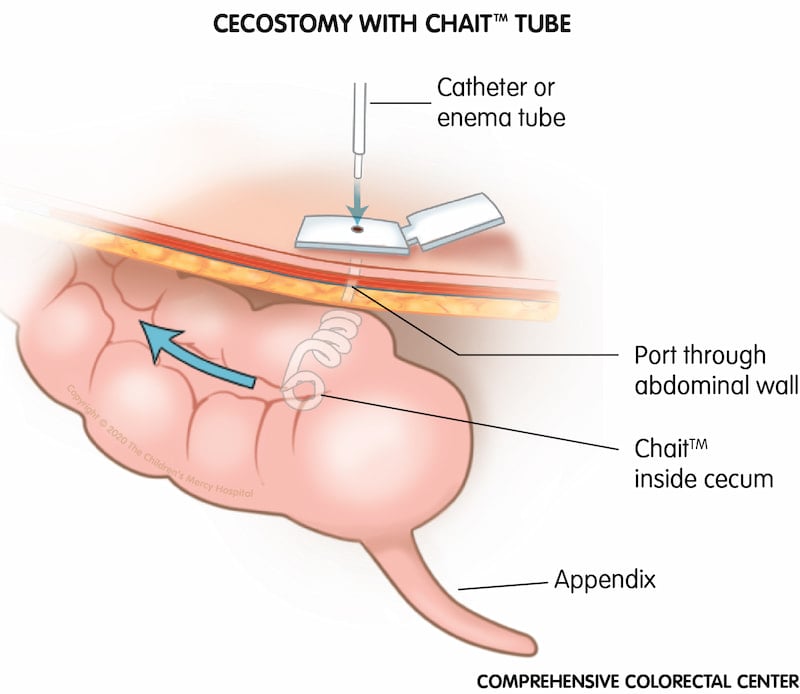 The Chait™ device can be used as a type of tube during cecostomy or appendicostomy (MACE/Malone) surgery. This device makes it easier to find the hole to perform the enema.