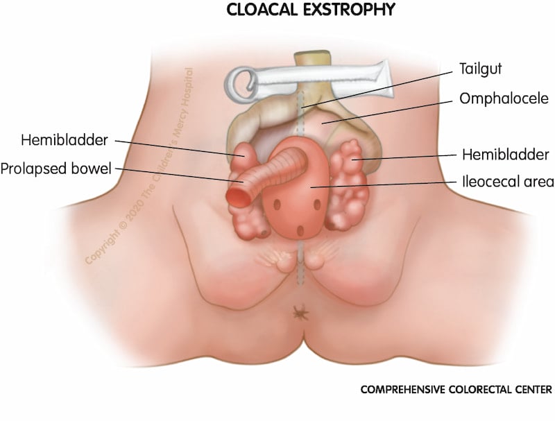 When a baby is born with cloacal exstrophy, part of the intestines may be outside of the body (called omphalocele) and a portion of the small bowel called the terminal ileum may also stick out further, called prolapse. The small bowel (prolapse) comes out into the opened beginning part of the colon called the cecum. This means that poop does not come out of the anal opening (hindgut). The bladder may be outside of the body and in two pieces (called hemibladder). Urine (pee) drains directly onto the bladder plates through the ureters.