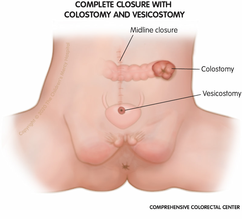 After complete closure, the bladder will be tucked into the abdomen and will empty through an opening in the tummy wall (vesicostomy). There is a hole on the side of the abdomen that allows poop to exit the body (colostomy).