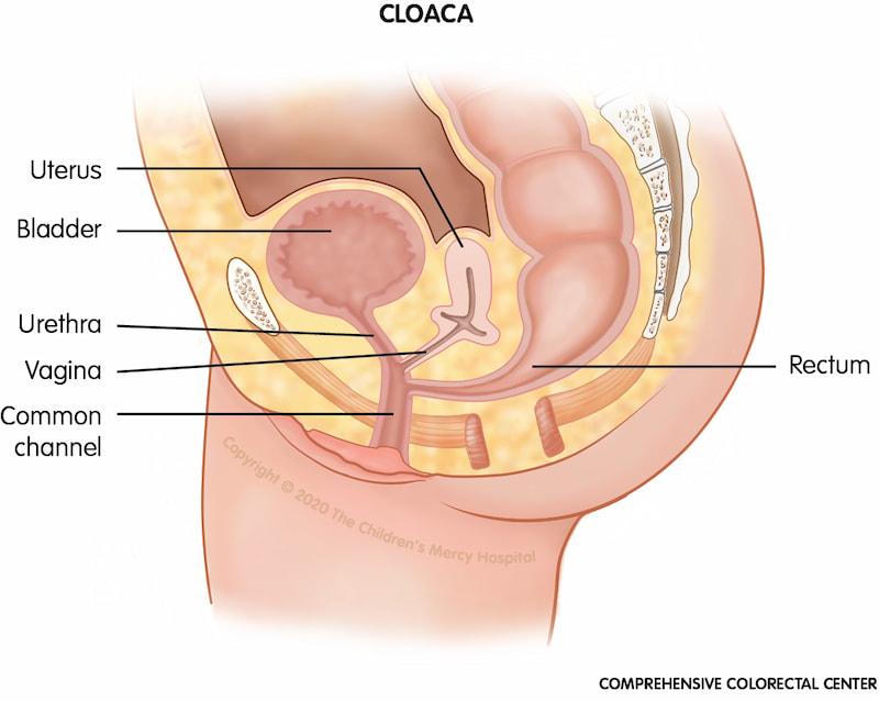 Cloaca is a type of anorectal malformation in which the rectum, vagina and urinary tract are joined. This "common channel" ends in a single opening on the baby's bottom. The external private parts may look normal until closer inspection takes place.