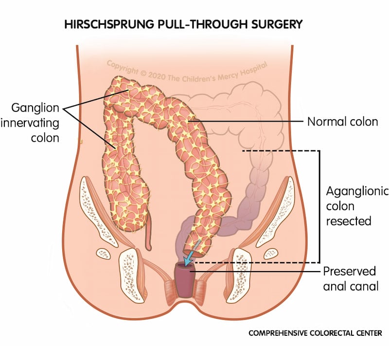Hirschsprung pull-through surgery removes the portion of the colon that doesn't have ganglion cells and attaches the healthy part of the colon right above the anal canal.