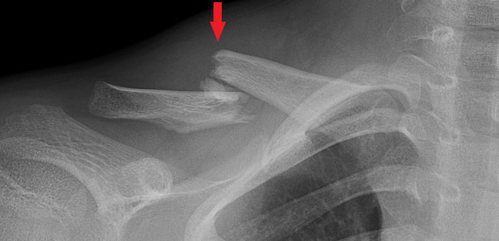 X-ray of the right collarbone (clavicle). The red arrow shows a comminuted fracture. A comminuted fracture is one where the bone is broken into more than two pieces.