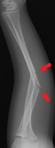 Side-view (lateral) x-ray of the left forearm. The bottom arrow shows a fracture of the radius shaft and the top arrow shows a fracture of the ulna shaft.