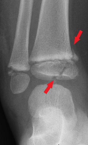 Front-view (anteroposterior) x-ray of the left ankle. The red arrows show a fracture in the shinbone near the foot (distal tibia Salter-Harris IV fracture). The image also shows a fracture in the other leg bone near the foot (distal fibula Salter-Harris II fracture). Salter-Harris fractures involve the growth plates on the ends of a child’s bones.