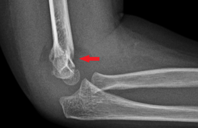 Side-view (lateral) x-ray of the right elbow. The red arrow shows a fracture of the upper arm bone near the elbow (supracondylar humerus fracture).